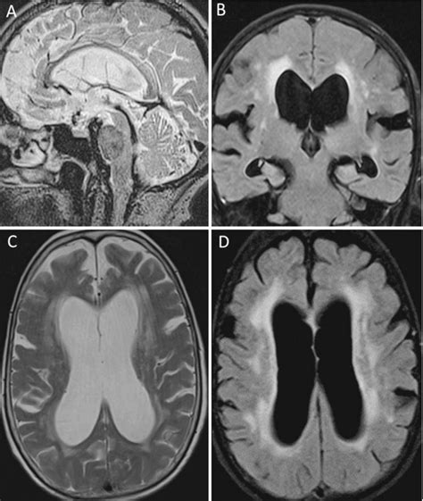 Fig 26 Idiopathic Normal Pressure Hydrocephalus With Diseases Of The Brain Head And