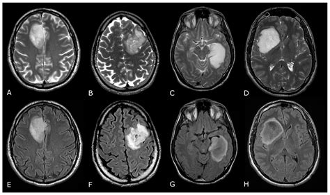 Biomedicines Free Full Text Magnetic Resonance Imaging Of Primary Adult Brain Tumors State