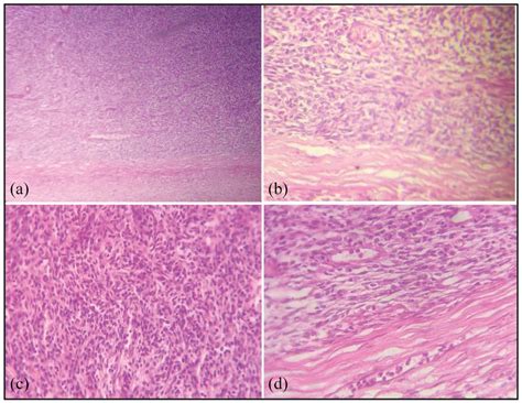 Spindle Shaped Tumor Cells Arranged In Fascicles And Bundles Occupying