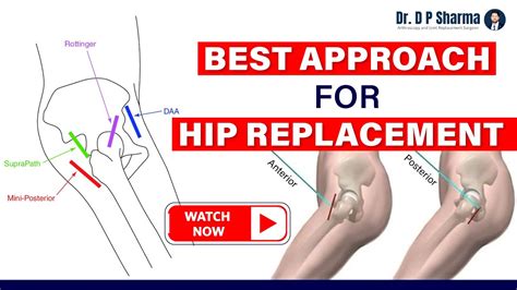 Know The Best Approach For Hip Replacement By 360 Degree Hip Surgeon In India Dr Dp Sharma