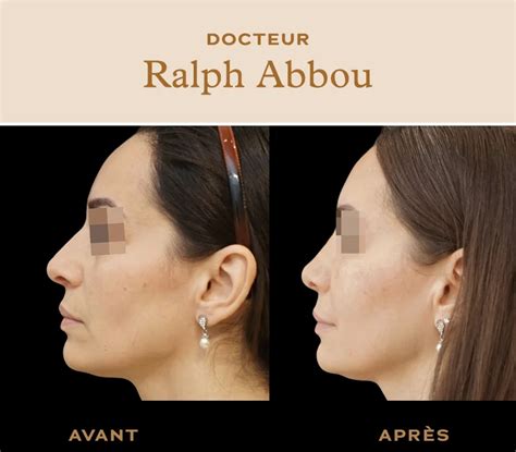 Rhinoplastie naturelle à Paris Dr Ralph ABBOU