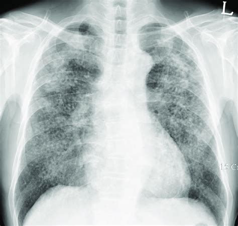 Silicosis In A 66 Year Old Man Chest Radiograph Shows Characteristic