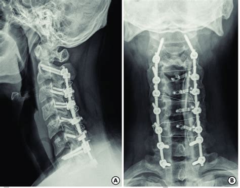 A Recent Plain Radiograph Of The Cervical Spine Lateral View A