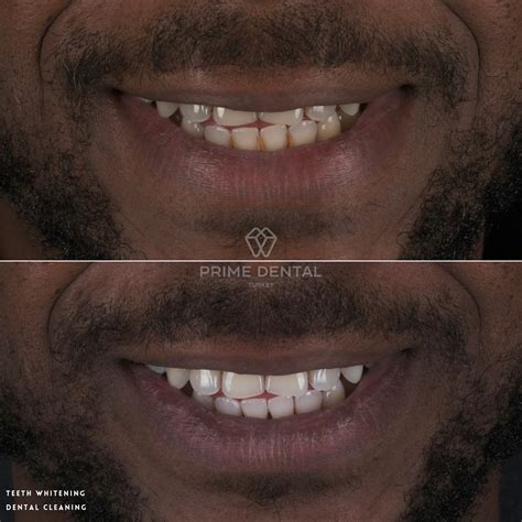 Teeth Whitening Before & After Photos - Prime Dental Turkey