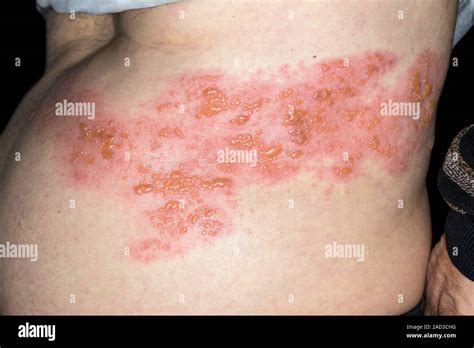 La culebrilla o herpes zoster erupción en la piel del paciente El