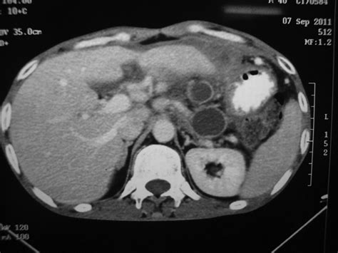 Primary Disseminated Extrahepatic Abdominal Hydatid Cyst A Rare Disease Bmj Case Reports