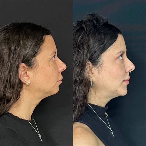 O Que É Mento No Rosto - O que é mento no rosto? | Harmonização Facial | Dr. Fabio Barros | Rio ...