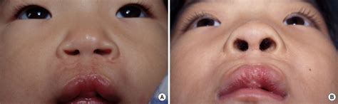 A 3 Year Old Girl With A Bilateral Cleft Lip Nasal Deformity With A Download Scientific Diagram