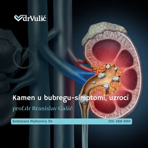 Kamen U Bubregu Simptomiuzroci Zakažite Pregled Kod Nefrologa