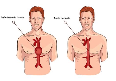 An Vrisme De L Aorte Abdominale Causes Surveillance Complications