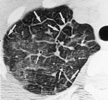 Eosinophilic Lung Diseases Arthritis Rheumatism