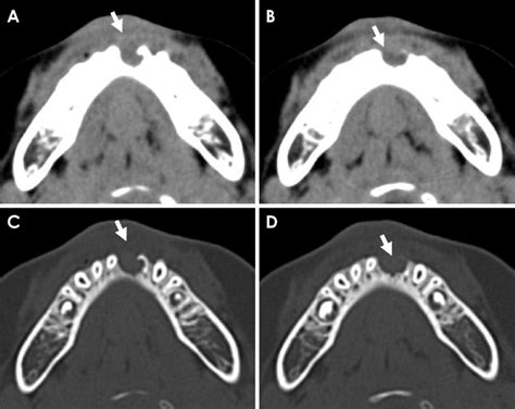 Axial Soft Tissue Algorithm CT Images A And B Show A Mass Lesion