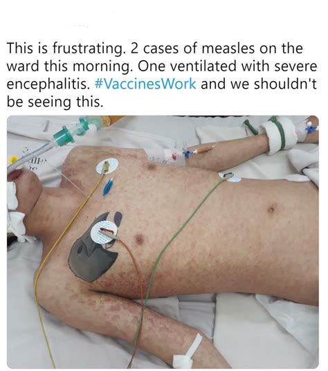 Measles Is Making A Comeback And Here Is Proof Scrolller