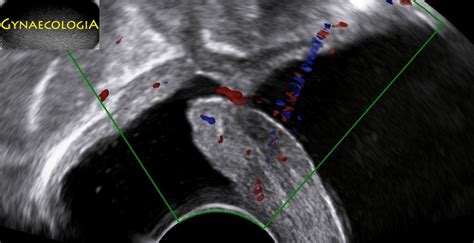 Vesicovaginal Fistula After Hysterectomy Gynaecologia