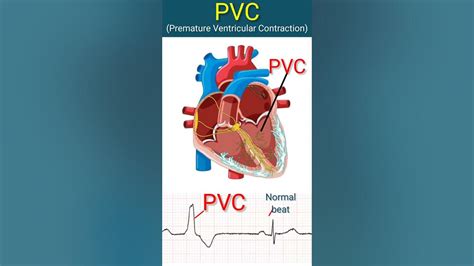 Heart With Pvcs L Heart Ecg Shorts Youtube