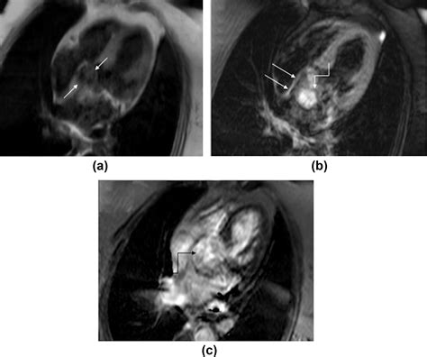 Cardiac Mri For The Evaluation Of Cardiac Neoplasms Clinical Radiology