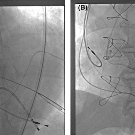 Corevalve Evolut R 29 Mm Implantation The Calcified Valve Leaflets