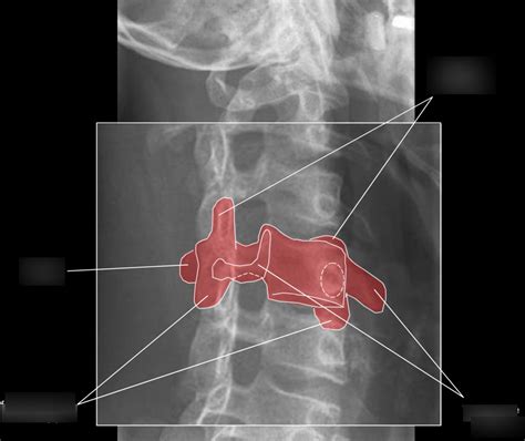 Cervical Oblique Diagram Quizlet