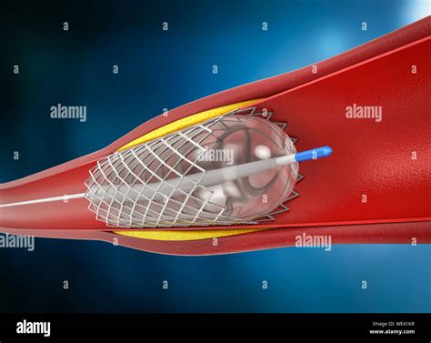 D Rendering Angioplastia Con Globo Procedimiento Con Stent En Vena