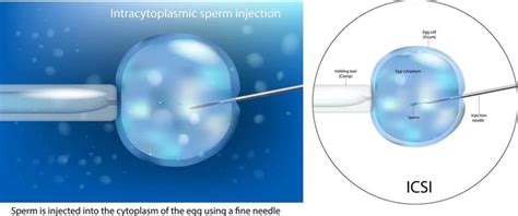 Icsi Vs Ivf Difference Between Ivf And Icsi Grace Fertilty