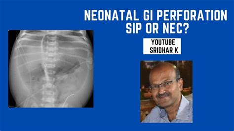 Neonatal Pneumoperitoneum Gut Perforation Sip Or Nec Sip Nec