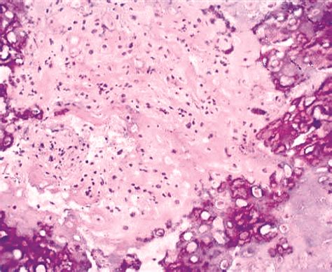 Pathology Outlines Bizarre Parosteal Osteochondromatous Proliferation