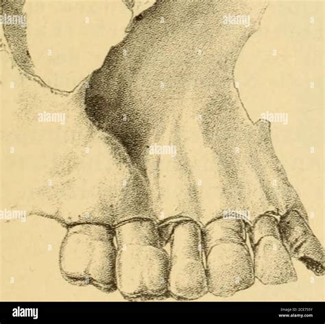 Ausbuchtung hi-res stock photography and images - Alamy