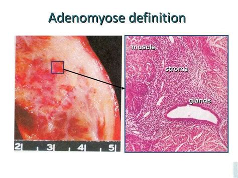 adenomyosis - gynsurgery.org