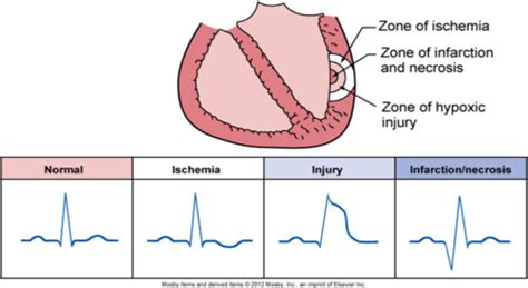 Patho 2 Cardiac Coronary Artery Disease Angina Myocardial