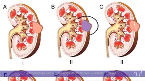 Dr Jo O Juveniz Cistos Renais Complexos Youtube