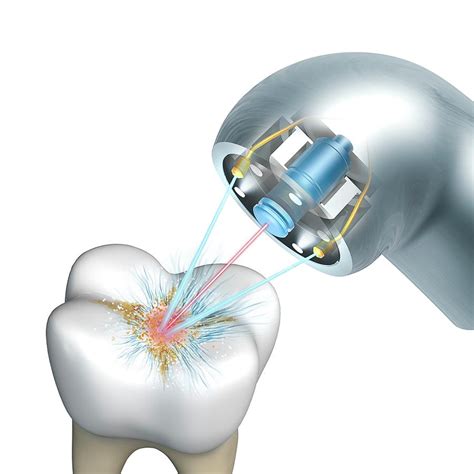 Dental Hygiene Laser By Henning Dalhoff Science Photo Library