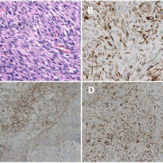 Histological And Immunohistochemical Analysis Of The Specimen Spindle