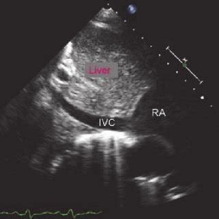 Ultrasound Determination Of Inferior Vena Cava Ivc Diameter Ra Right