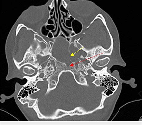 Figure From A Rare Case Of Adamantinomatous Craniopharyngioma In An