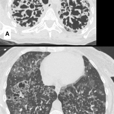 Anteroposterior Chest Radiograph Taken At Time Of Admission This Image