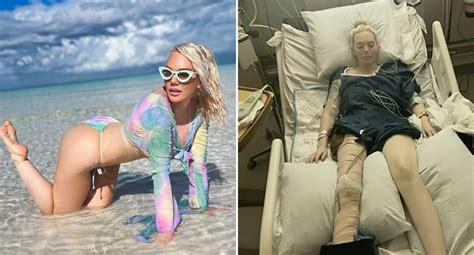 Womans Leg Amputated After Contracting Flesh Eating Bacteria On Holiday