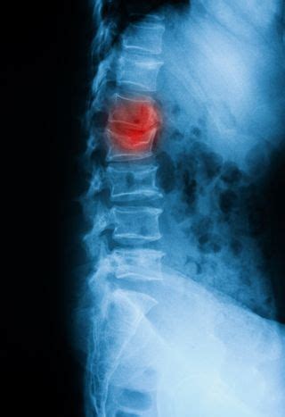 Vertebral Compression Fractures | Murfreesboro Vascular and Interventional