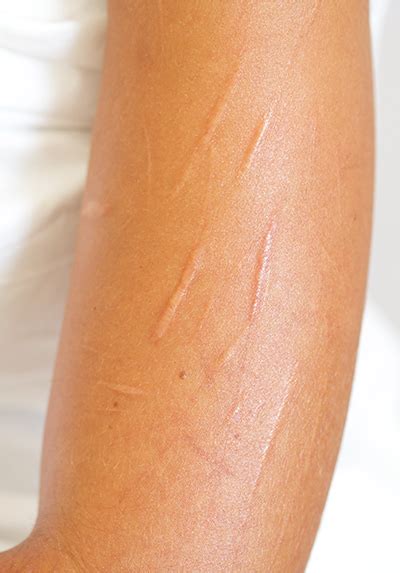 Help Your Teen By Knowing The Signs Of Self Harm Hmg Health Matters Blog