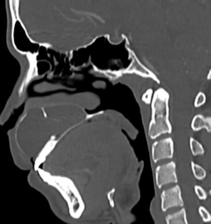 Odontogenic Keratocyst Maxilla Image Radiopaedia Org