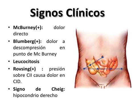 10 SÍntomas De La Apendicitis ~ Mi Salud