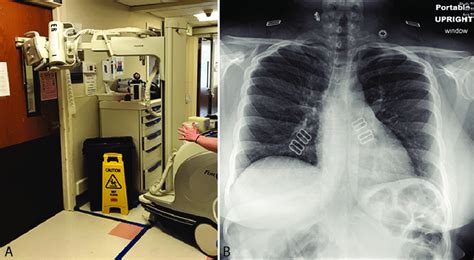 Chest Radiography Through Glass A Technologists Position The Portable