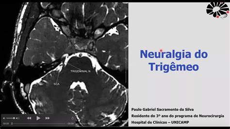 Neuralgia Do Trig Meo Youtube