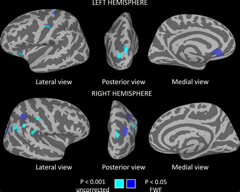 Gyrification Abnormalities In Presymptomatic C Orf Expansion Carriers