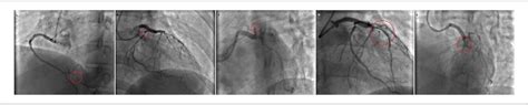 Figure From The South African Flag Sign An Electrocardiographic Flag