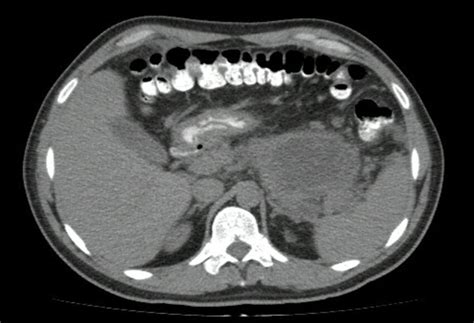 Tomografía De Abdomen Fuente Archivo De Los Autores Download
