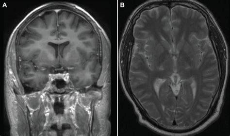 X Linked Adrenoleukodystrophy X Ald Clinical Presentation And