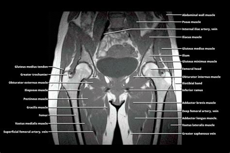 Pelvic Mri Anatomy