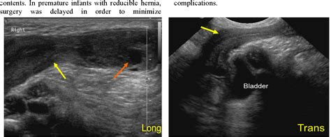 [pdf] Inguinolabial Hernia Containing Ovary Fallopian Tube And Uterus