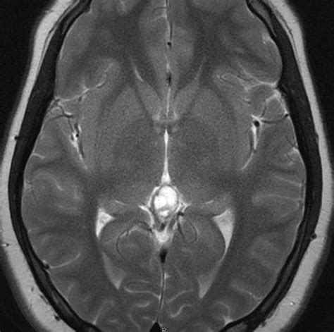 Pineal Gland Mri