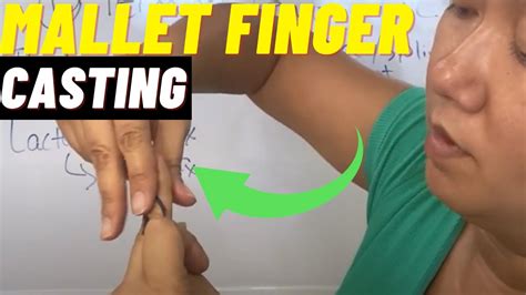 How To Cast A Mallet Finger Immobilization Of Mallet Finger With